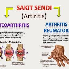 Bahagian sendi lain termasuk pinggul , bahu, lutut, dan pergelangan kaki. Apa Itu Penyakit Arthritis Punca Simptom Dan Rawatannya