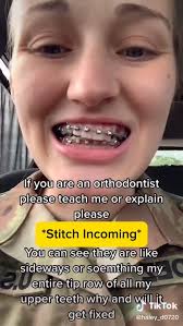 Canted teeth after getting braces? It’s often due to impacted canines  shifting things around. , Don’t wait! Mention this to your Orthodontist as  soon as you see this, so it doesn’t worsen!, ...