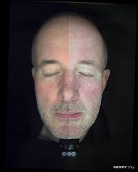 ✨ Just 2 weeks difference, using the right medical grade routine! These  before & after skin analysis images show how quickly the skin can change  when inflammation is properly treated. What you're