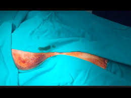 Ventriculoperitoneal Shunt Standard Technique Youtube