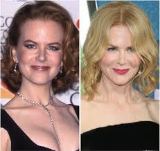 Nicole Kidman Plastic Surgery