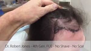 Hair loss treatments for men and women. Female Hair Loss Toronto Hair Transplant Dr Jonathan Huber Dr Robert Jones