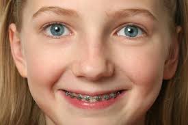 Braces Smile Kids Ortho Dentist Orthodontics Braces Orthodontics Braces Smile
