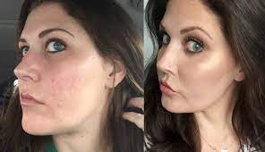 Check spelling or type a new query. I Nixed My Acne Scars For Good With Fractional Co2 Laser Resurfacing Healthy You