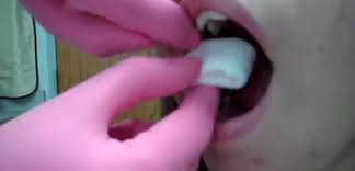Image result for Post-Tooth Extraction Bleeding