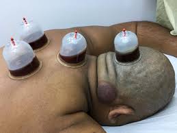 الحجامة هي من اشكال العلاج الطبي والمتداول بين الناس بشكل كبير لما يحتويه من فوائد عديدة للصحه ولخصائصها في تجديد الدورة الدموية وتحسين الصحه بشكل عام في هذا. Ø¨Ø§Ù„ØµÙˆØ± Ø§Ù„Ø­Ø¬Ø§Ù…Ø© ØªØµÙ†Ø¹ Ù…Ø¹Ø¬Ø²Ø© ÙÙŠ ØµÙ„Ø§Ù„Ø© Ø§Ù„Ø­ÙŠØ§Ø© Ù†ÙŠÙˆØ²