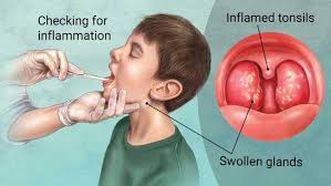 Image result for Tonsillitis