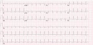 In such cases of cardiac tamponade, ekg or holter monitor will then depict electrical alternans indicating wobbling of the heart in the fluid filled pericardium, and the capillary refill might decrease. Pericarditis Electrocardiogram Wikidoc