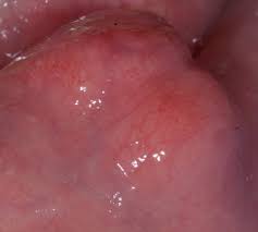 Image result for Labial mucosa