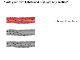 We did not find results for: 0814 Types Of Thrombosis Medical Images For Powerpoint Presentation Powerpoint Diagrams Ppt Sample Presentations Ppt Infographics