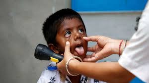 Maybe you would like to learn more about one of these? Eyes Of Three Children Infected With Black Fungus Removed In Mumbai 16 Year Old Develops Fungus In Stomach