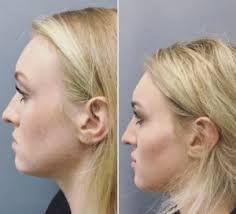 Affordable Dermal Fillers
