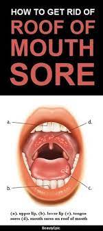5 Simple Ways To Get Rid Of Roof Of Mouth Sore At Home Roof Of Mouth Sore Mouth Sores Sore In Mouth Remedies