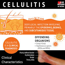 Image result for Cellulitis