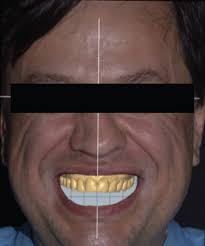 Correction of Vertical Smile Discrepancy through Ceramic Laminate Veneers  and Surgical Crown Lengthening