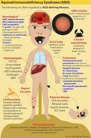 Image result for AIDS-Defining Illness