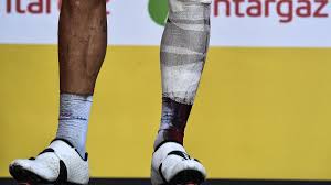 Women's tour de france will take my sport to another level. Tour De France 2018 Photos Reveal Philippe Gilbert S Horrific Injuries And Astonishing Bravery Eurosport