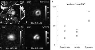 Hyperpolarized 13C Metabolic MRI of the Human Heart | Circulation Research