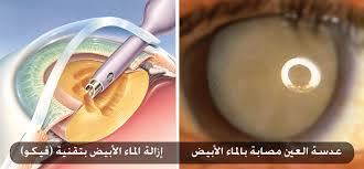 إزالة الماء الأبيض لا تخدير لا خياطة لا ألم