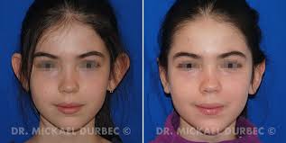 Après une intervention de 45 minutes à 1h, l'oreille est plus proche du crâne. Otoplastie A Lyon Chirurgie Esthetique Des Oreilles Decollees Dr Durbec