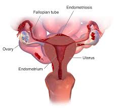 Without the hormonal drugs the endometriosis after a laparoscopy can return, because three months after surgery ultrasound is. Endometriosis Clinical Features Diangosis Teachmeobgyn