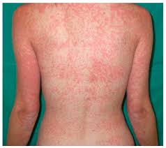 Image result for Papular urticaria