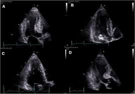 Learn more about causes, risk factors, screening and prevention, signs and symptoms, diagnoses, and treatments for cardiomyopathy, and how to participate in clinical trials. The Role Of Echocardiography For Diagnosis And Prognostic Stratification In Hypertrophic Cardiomyopathy Springerlink