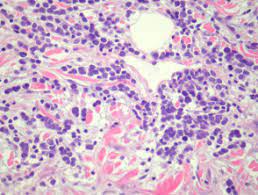 Merkel cell carcinoma is a very rare disease in which malignant (cancer) cells form in the skin. Merkel Cell Carcinoma Pathology Dermnet Nz