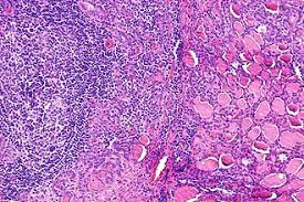 Image result for Thyroiditis