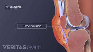 Image result for Prepatellar Bursitis