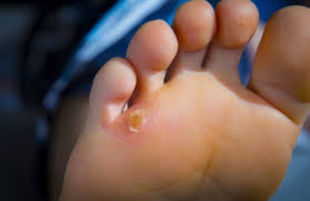 Plantar warts treatment and removal for adults and children. Warts Arkansas Foot Ankle Specialists Fayetteville Arkansas