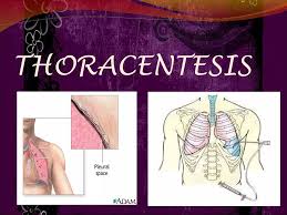 Image result for Thoracentesis