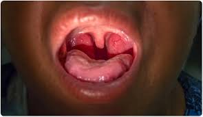 Tonsillitis is more common in children and teenagers, but there is nothing that prevents adults from getting it. Functions Of Tonsils