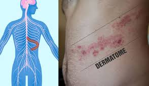 Image result for herpes zoster