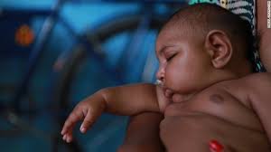 Image result for picture of BABIES WITH ZIKA VIRUS