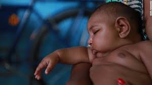 Image result for pictures of zika babies