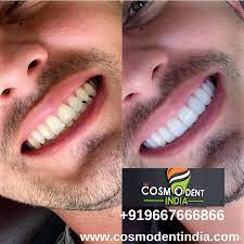 Dental Veneers In India Dental Veneers Cost Dental Veneers Dental Cosmetics