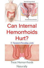 Why Do Hemorrhoids Leak Fluid Do Hemorrhoids Stop Bleeding What To Eat Before Hemorrhoid Surgery Varicose Vein Remedy Getting Rid Of Hemorrhoids Hemorrhoids