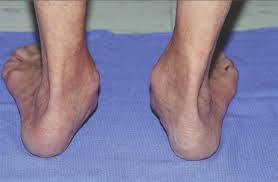 Maybe you would like to learn more about one of these? Posterior Tibial Tendon Insufficiency Ptti Foot Ankle Orthobullets