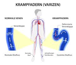 10 фраз в 2 тематиках. Was Sind Krampfadern