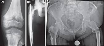 Radiology Of Rickets And Osteomalacia Sciencedirect
