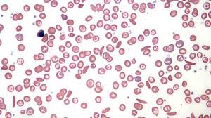 Sickle cell disease is inherited when a child inherits two abnormal hemoglobin genes, one from each parent. Sickle Cell Anemia Traced Back To One Baby Born 7300 Years Ago Science Aaas