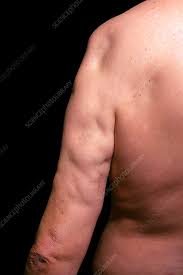 Image result for Panniculitis