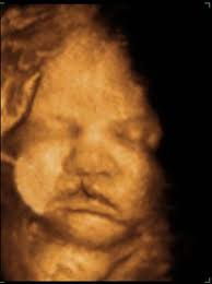 Ultrasound Of Cleft Lip And Palate Cleft Lip And Palate Cleft Lip Ultrasound