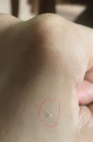 Skin Concerns Anyone Else Get Pores Clogged With White Plugs Skincareaddiction