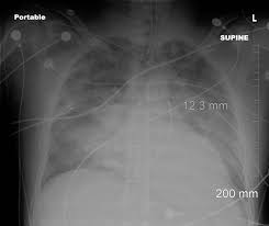 Image result for Air Bronchogram