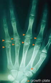 Image result for Hand Growth Plates
