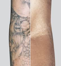 The amount of treatments you need depends on the size of the tattoo, the color, the location, what type of ink was used, your skin color and your skin's ability to heal. Laser Therapeutics Laser Tattoo Removal