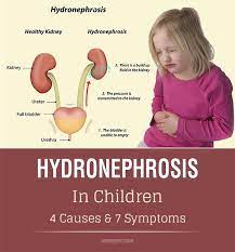 Health Fitness Archives Momjunction Reflux In Children Medical Knowledge Healthy Tips For Kids