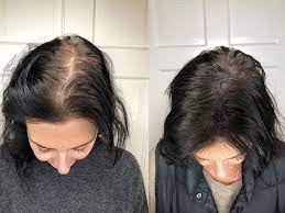What causes extremely dry scalp. Scalp Micropigmentation Benefits Side Effects Before After Pics